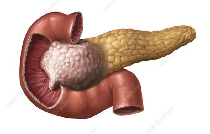 Pancreatic Cancer