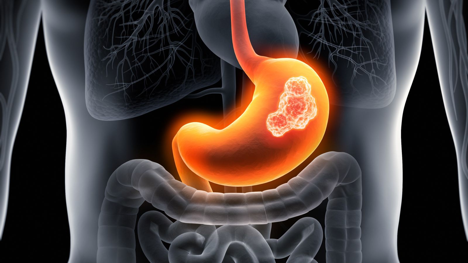 Gastric Cancer